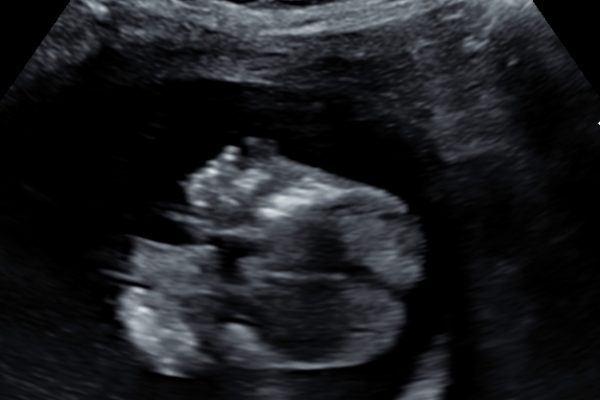 3d-4d-ultrasound6